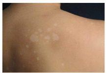 Imate li ove bijele mrlje po cijelom tijelu? Evo zašto se pojavljuju i što znače