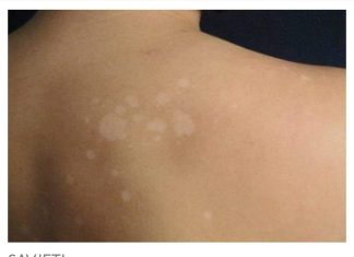 Imate li ove bijele mrlje po cijelom tijelu? Evo zašto se pojavljuju i što znače