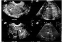 Sve više žena umire od raka maternice: 6 jasnih znakova da se ovaj opasni tumor razvija u tijelu!