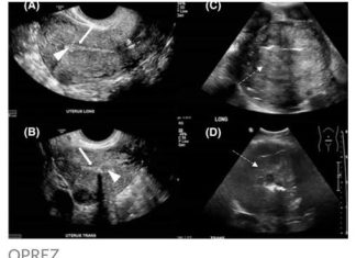 Sve više žena umire od raka maternice: 6 jasnih znakova da se ovaj opasni tumor razvija u tijelu!