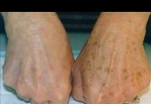 Smeđe mrlje su česte na tijelu, ali postoji način da ih se riješite: Dermatolozi otkrivaju tajnu, a ova mješavina od dva sastojka čini čuda!