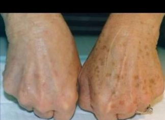 Smeđe mrlje su česte na tijelu, ali postoji način da ih se riješite: Dermatolozi otkrivaju tajnu, a ova mješavina od dva sastojka čini čuda!