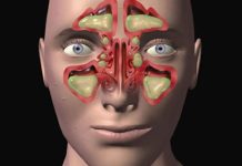 Najsnažniji lijek za sinuse sa samo 2 sastojka: Začas ćete disati (Formula)