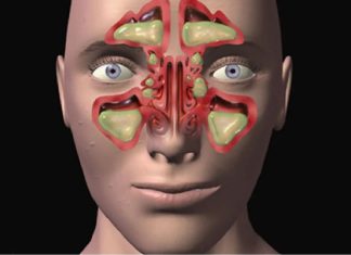 Najsnažniji lijek za sinuse sa samo 2 sastojka: Začas ćete disati (Formula)