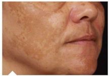 Najbolji dermatolozi otkrili su tajnu: pomiješajte ova dva sastojka i tamne mrlje će zauvijek nestati