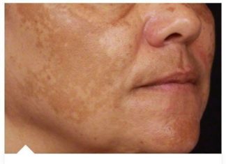 Najbolji dermatolozi otkrili su tajnu: pomiješajte ova dva sastojka i tamne mrlje će zauvijek nestati