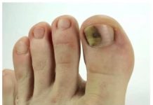 Ovo je najbolji lijek za onihomikozu: pomiješajte ove sastojke i potopite prste i nestat će preko noći