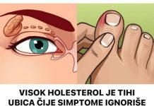 Visok holesterol je tihi ubica, a simptome ignoriše 96% ljudi. Ovi simptomi će vam spasiti život. br. 4 je posljednje upozorenje
