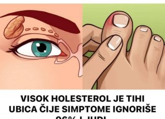 Visok holesterol je tihi ubica, a simptome ignoriše 96% ljudi. Ovi simptomi će vam spasiti život. br. 4 je posljednje upozorenje