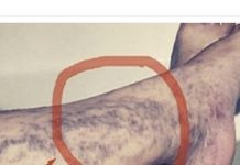 Svatko kod kuće ima lijek za popucale kapilare, ali mnogi ljudi to ne znaju!