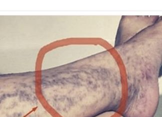 Svatko kod kuće ima lijek za popucale kapilare, ali mnogi ljudi to ne znaju!