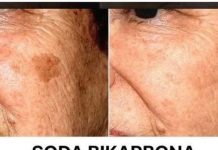 Koja je uloga sode bikarbone u liječenju mrlja na licu? Napisala Gordana Lakić.