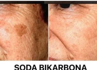 Koja je uloga sode bikarbone u liječenju mrlja na licu? Napisala Gordana Lakić.