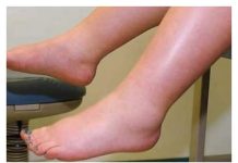 Potreban vam je vitamin da biste se riješili viška vode: noge vam više neće oticati, samo ga uključite u prehranu