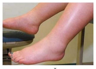 Potreban vam je vitamin da biste se riješili viška vode: noge vam više neće oticati, samo ga uključite u prehranu