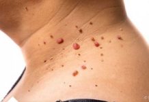 Uklonite papilome jednom radnjom: koristite specifičan prehrambeni proizvod koji ne samo da preporučuju medicinski stručnjaci, već je i lako dostupan u vašem domu.