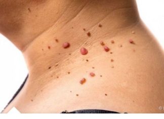 Uklonite papilome jednom radnjom: koristite specifičan prehrambeni proizvod koji ne samo da preporučuju medicinski stručnjaci, već je i lako dostupan u vašem domu.