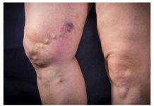 Iskusite nevjerojatnu ljekovitost ovog biljnog lijeka koji nudi potpuno prirodno rješenje za liječenje proširenih vena.