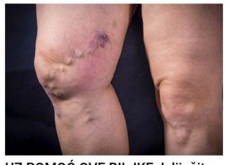 Iskusite nevjerojatnu ljekovitost ovog biljnog lijeka koji nudi potpuno prirodno rješenje za liječenje proširenih vena.