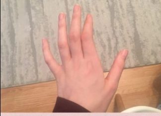 TRNU VAM PRSTI ILI RUKE? OVAJ SIMPTOM VAS UPOZORAVA NA: Odmah budite oprezni.