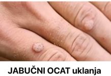 Pripremite domaći jabučni ocat i njime uklonite bradavice.