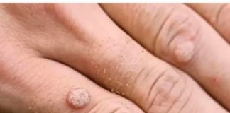 Pripremite domaći jabučni ocat i njime uklonite bradavice.