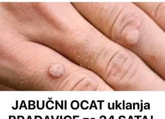 Pripremite domaći jabučni ocat i njime uklonite bradavice.