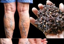 Moja baka nije mogla hodati zbog bolova u nogama i proširenih vena – onda smo otkrili ovaj nevjerojatan lijek koji ju je vratio na noge