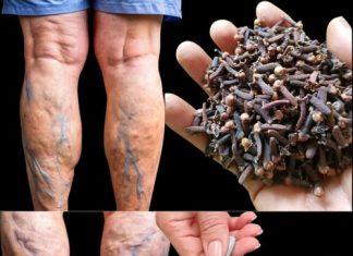 Moja baka nije mogla hodati zbog bolova u nogama i proširenih vena – onda smo otkrili ovaj nevjerojatan lijek koji ju je vratio na noge