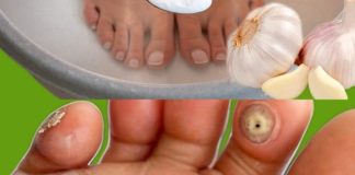 Imate kurje oko ili znate nekoga ko ga ima? Evo kako da ga se riješite preko noći sa ovom močnom mješavinom Imate kurje oko ili znate nekoga ko ga ima? Evo kako da ga se riješite preko noći sa ovom močnom mješavinom - featured image