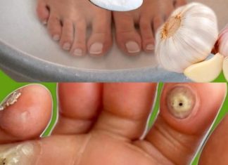 Imate kurje oko ili znate nekoga ko ga ima? Evo kako da ga se riješite preko noći sa ovom močnom mješavinom Imate kurje oko ili znate nekoga ko ga ima? Evo kako da ga se riješite preko noći sa ovom močnom mješavinom - featured image