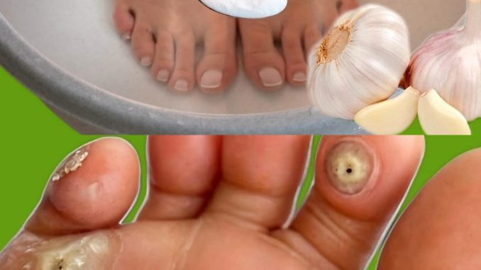 Imate kurje oko ili znate nekoga ko ga ima? Evo kako da ga se riješite preko noći sa ovom močnom mješavinom - featured image Imate kurje oko ili znate nekoga ko ga ima? Evo kako da ga se riješite preko noći sa ovom močnom mješavinom - featured image