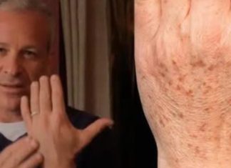 Sok od luka + jabukovo sirće: Samo pomiješajte i riješite se staračkih pjega na rukama, licu i dekolteu jednom za svagda! Sok od luka + jabukovo sirće: Samo pomiješajte i riješite se staračkih pjega na rukama, licu i dekolteu jednom za svagda! - featured image