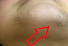 ZNATE LI ZAŠTO SE KOD ŽENA JAVLJAJU DLAČICE NA BRADI? Evo šta vam organizam govori ZNATE LI ZAŠTO SE KOD ŽENA JAVLJAJU DLAČICE NA BRADI? Evo šta vam organizam govori - featured image