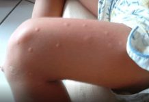 KOMARCI VAM PRAVE PAKAO OD ŽIVOTA? Samo isijecite OVO VOĆE na pola i ostavite u sobi, VIŠE IH NIKADA NEĆETE VIDJETI BLIZU! KOMARCI VAM PRAVE PAKAO OD ŽIVOTA? Samo isijecite OVO VOĆE na pola i ostavite u sobi, VIŠE IH NIKADA NEĆETE VIDJETI BLIZU! - featured image