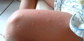 KOMARCI VAM PRAVE PAKAO OD ŽIVOTA? Samo isijecite OVO VOĆE na pola i ostavite u sobi, VIŠE IH NIKADA NEĆETE VIDJETI BLIZU! KOMARCI VAM PRAVE PAKAO OD ŽIVOTA? Samo isijecite OVO VOĆE na pola i ostavite u sobi, VIŠE IH NIKADA NEĆETE VIDJETI BLIZU! - featured image