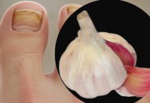 Trenutačno uklanja gljivice na noktima poput gumice! Najbolji prirodni lijek! Efikasnost 100% Trenutačno uklanja gljivice na noktima poput gumice! Najbolji prirodni lijek! Efikasnost 100% - featured image