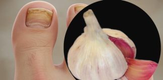 Trenutačno uklanja gljivice na noktima poput gumice! Najbolji prirodni lijek! Efikasnost 100% Trenutačno uklanja gljivice na noktima poput gumice! Najbolji prirodni lijek! Efikasnost 100% - featured image