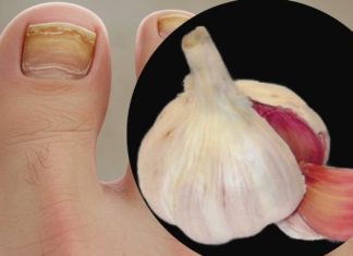 Trenutačno uklanja gljivice na noktima poput gumice! Najbolji prirodni lijek! Efikasnost 100% Trenutačno uklanja gljivice na noktima poput gumice! Najbolji prirodni lijek! Efikasnost 100% - featured image