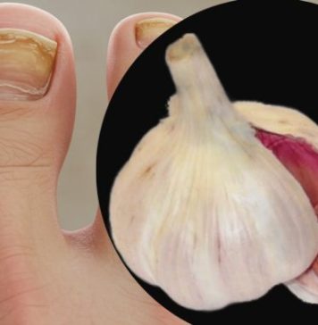 Trenutačno uklanja gljivice na noktima poput gumice! Najbolji prirodni lijek! Efikasnost 100% Trenutačno uklanja gljivice na noktima poput gumice! Najbolji prirodni lijek! Efikasnost 100% - featured image