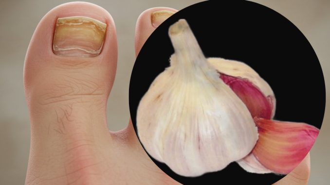 Trenutačno uklanja gljivice na noktima poput gumice! Najbolji prirodni lijek! Efikasnost 100% Trenutačno uklanja gljivice na noktima poput gumice! Najbolji prirodni lijek! Efikasnost 100% - featured image