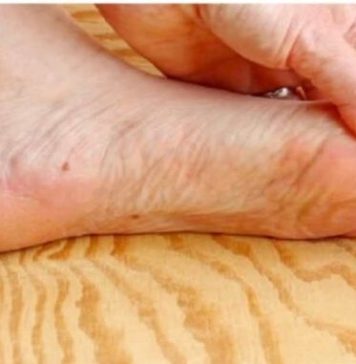 7 znakova da se tijelo već duže vrijeme bori s VISOKIM ŠEĆEROM UKRVI: Prvo ćete to primijetiti na očima i nogama! 7 znakova da se tijelo već duže vrijeme bori s VISOKIM ŠEĆEROM UKRVI: Prvo ćete to primijetiti na očima i nogama! - featured image