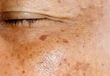 Staračke pjege po rukama i licu: Evo kako ih možete prirodno ukloniti Staračke pjege po rukama i licu: Evo kako ih možete prirodno ukloniti - featured image