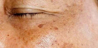 Staračke pjege po rukama i licu: Evo kako ih možete prirodno ukloniti Staračke pjege po rukama i licu: Evo kako ih možete prirodno ukloniti - featured image