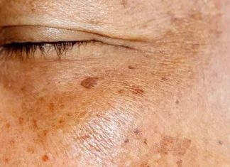 Staračke pjege po rukama i licu: Evo kako ih možete prirodno ukloniti Staračke pjege po rukama i licu: Evo kako ih možete prirodno ukloniti - featured image