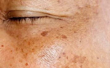 Staračke pjege po rukama i licu: Evo kako ih možete prirodno ukloniti Staračke pjege po rukama i licu: Evo kako ih možete prirodno ukloniti - featured image