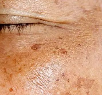 Staračke pjege po rukama i licu: Evo kako ih možete prirodno ukloniti Staračke pjege po rukama i licu: Evo kako ih možete prirodno ukloniti - featured image