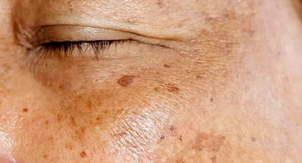 Staračke pjege po rukama i licu: Evo kako ih možete prirodno ukloniti - featured image Staračke pjege po rukama i licu: Evo kako ih možete prirodno ukloniti - featured image