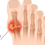 IZBACITE MOKRAĆNU KISELINU IZ TIJELA, IZBACITE GIHT: 3 narodna lijeka koja provjereno djeluju, OVO ĆE VAM POMOĆI! (RECEPT) IZBACITE MOKRAĆNU KISELINU IZ TIJELA, IZBACITE GIHT: 3 narodna lijeka koja provjereno djeluju, OVO ĆE VAM POMOĆI! (RECEPT) - featured image