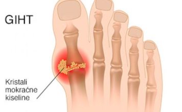 IZBACITE MOKRAĆNU KISELINU IZ TIJELA, IZBACITE GIHT: 3 narodna lijeka koja provjereno djeluju, OVO ĆE VAM POMOĆI! (RECEPT) IZBACITE MOKRAĆNU KISELINU IZ TIJELA, IZBACITE GIHT: 3 narodna lijeka koja provjereno djeluju, OVO ĆE VAM POMOĆI! (RECEPT) - featured image